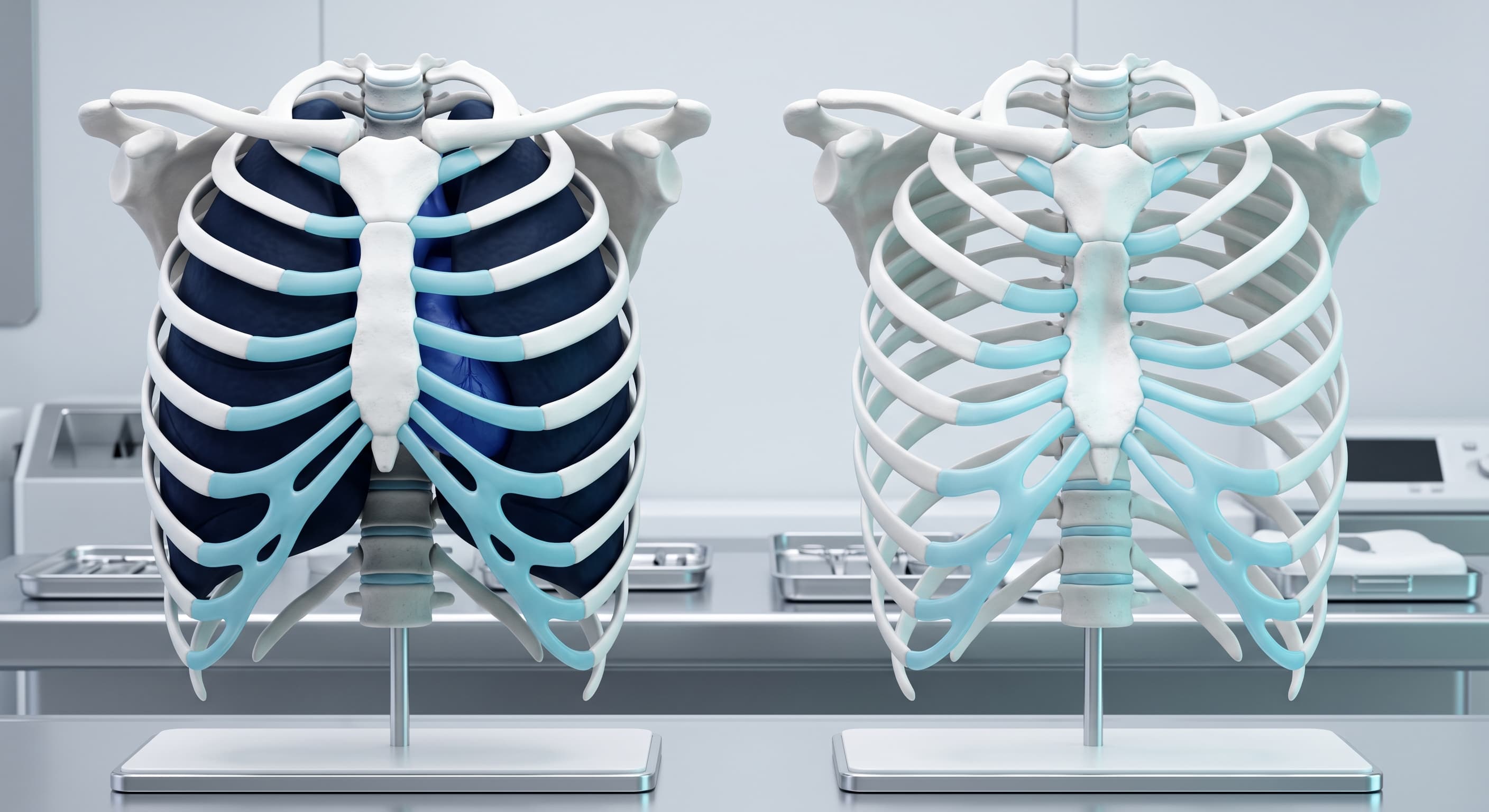 Ilustración Médica - Deformidades Torácicas (Pectus Excavatum y Carinatum)