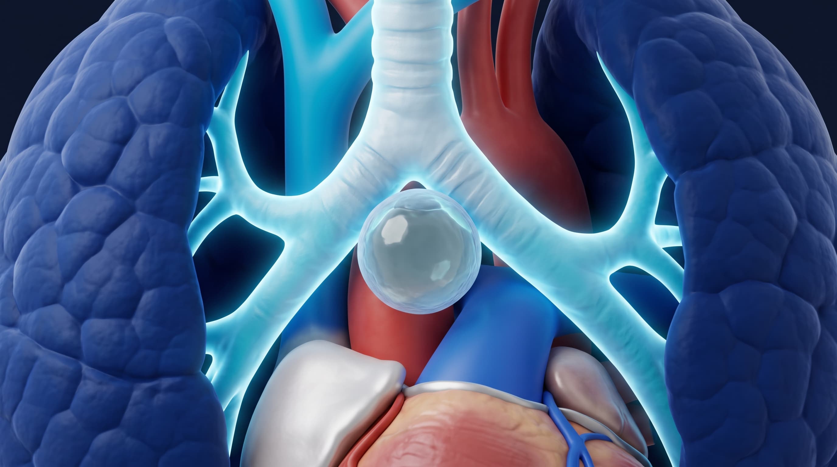 Ilustración Médica - Quistes Mediastinales (Broncogénicos y Pericárdicos)