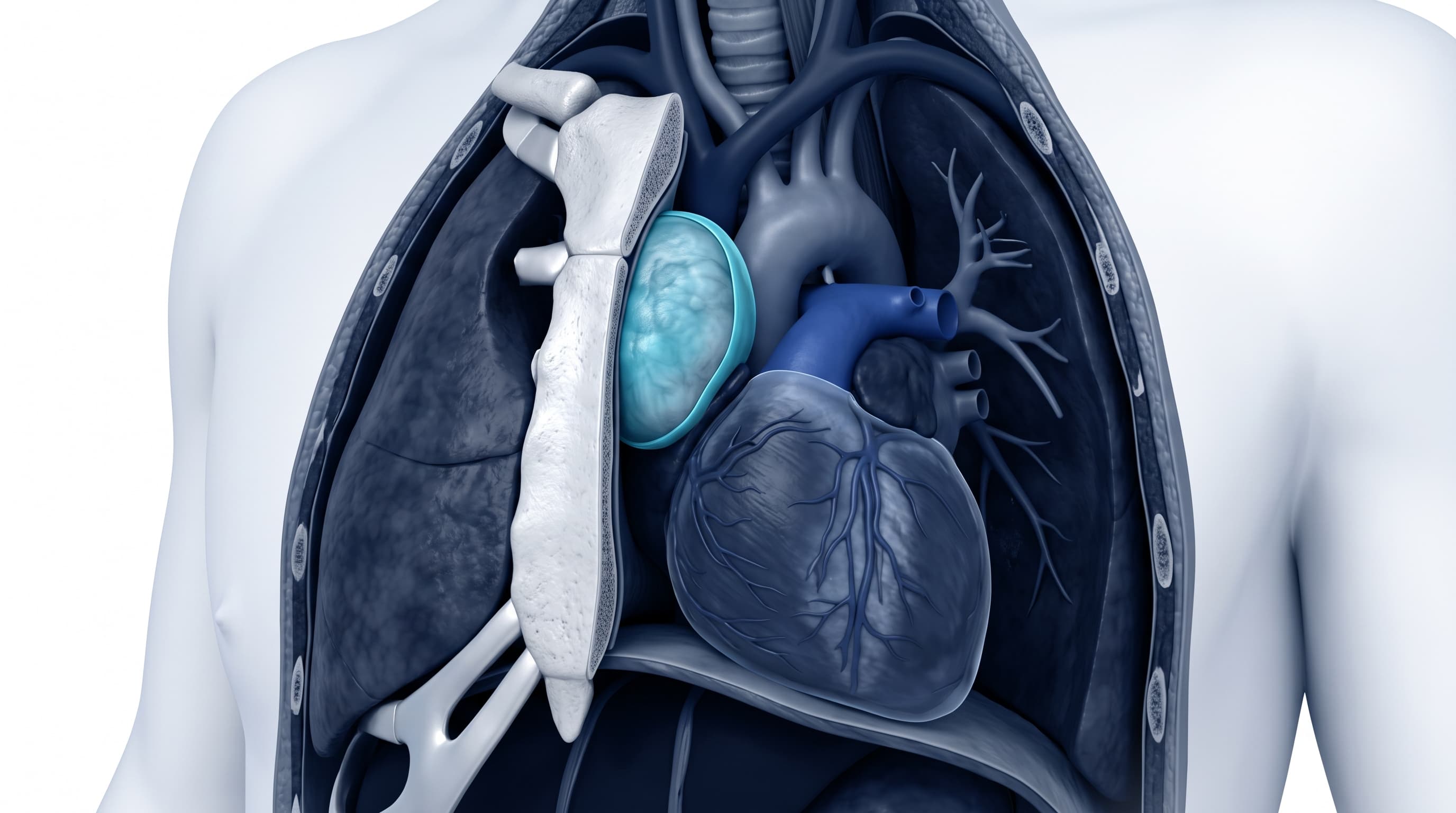 Ilustración Médica - Tumores del Mediastino y Timoma (Miastenia Gravis)