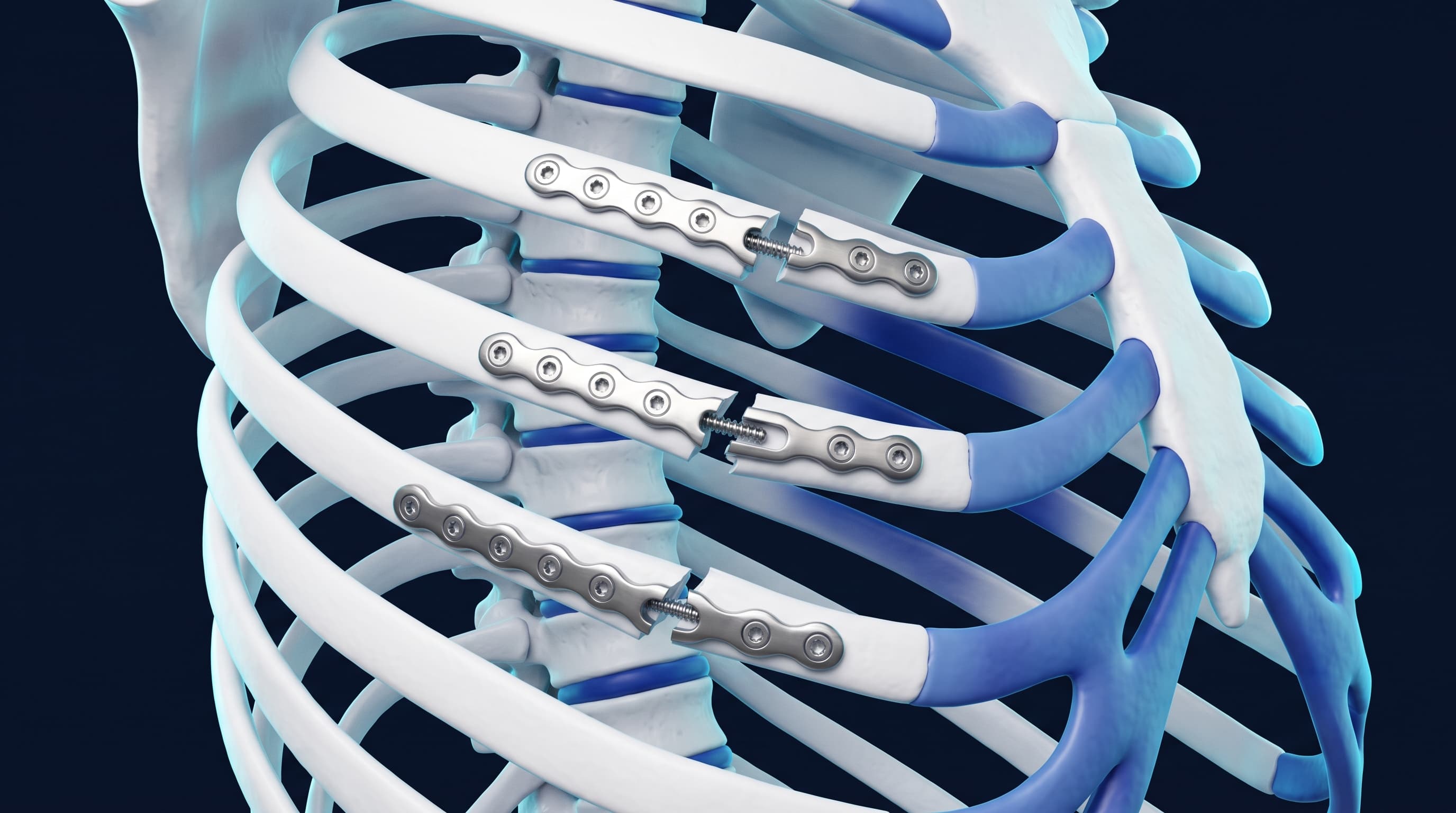 Fotografía Quirúrgica - Osteosíntesis Costal y Fijación de Fracturas con Placas de Titanio