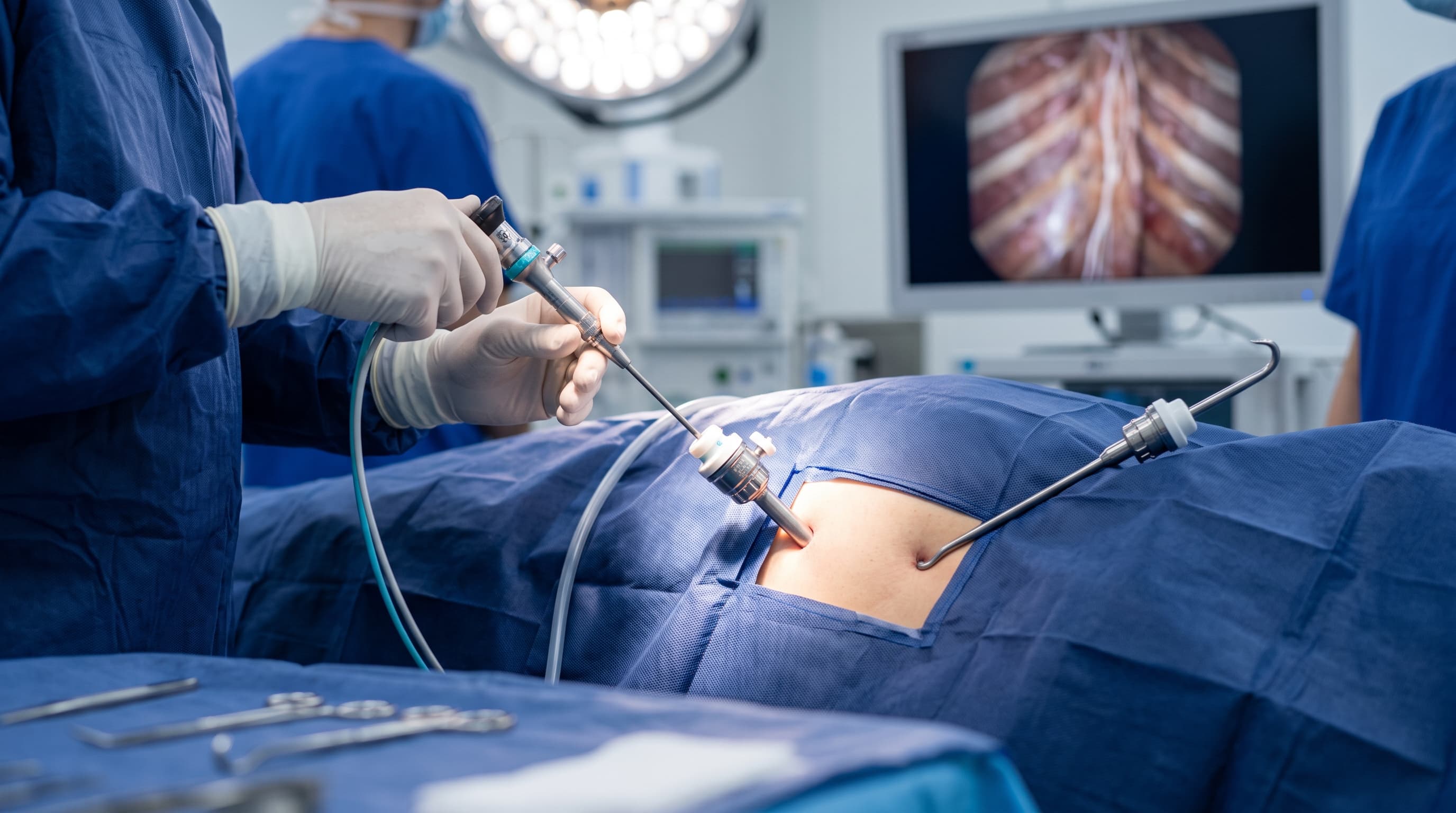 Fotografía Quirúrgica - Simpatectomía Torácica por VATS para Hiperhidrosis